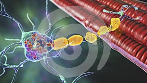Brain neurons in Tay-Sachs disease, 3D illustration photo
