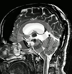 Brain pathology pineal cyst mri exam