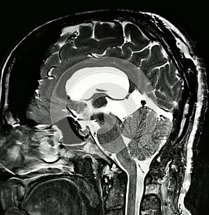 Brain pathology pineal cyst mri exam photo