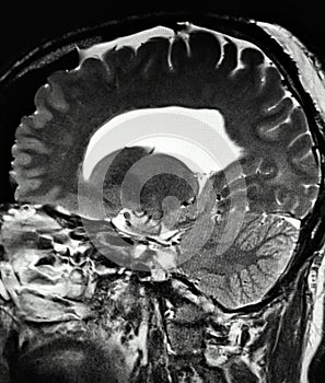 Brain pathology pineal cyst mri exam photo