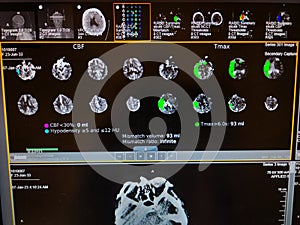 Brain Perfusion Scan - Right Middle Cerebral Artery Occlusion photo