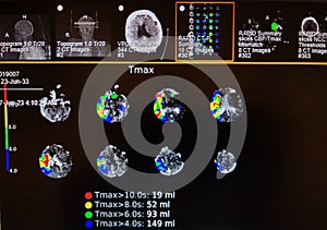 Brain Perfusion Scan - Right Middle Cerebral Artery Occlusion photo