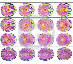 Brain perfusion MR imaging photo