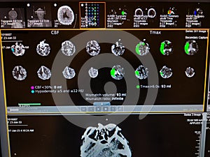 Brain Perfusion Scan - Right Middle Cerebral Artery Occlusion