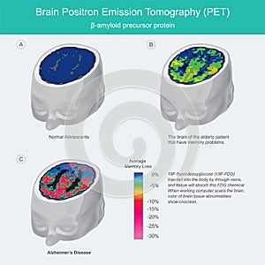 Brain PET scans. photo