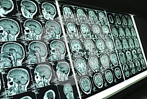 Brain x-ray001