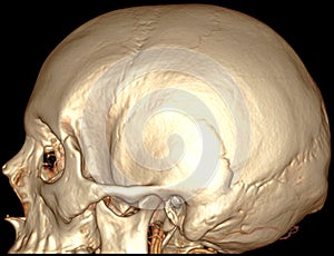 Brain sagital 3D CT photo