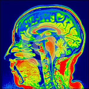 Brain sagital MRI photo
