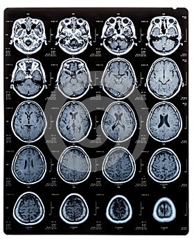 Brain scan image on Magnetic Resonance Imaging (MRI) film of elderly patient isolated (clipping path) photo