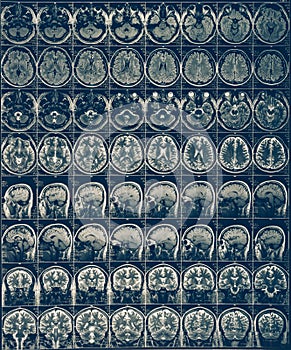 Brain scan X-ray Mri or Magnetic resonance imaging of human head, neurology concept