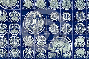 Brain scan X-ray Mri or Magnetic resonance imaging of human head, neurology concept