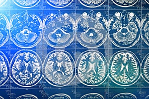 Brain scan X-ray Mri or Magnetic resonance imaging of human head, neurology concept photo