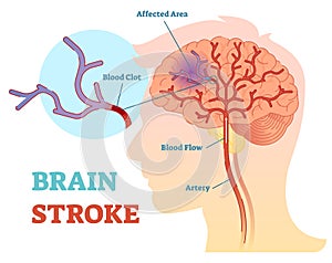 Cerebro ataque anatómico ilustraciones sistema 