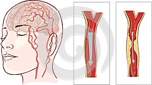 Brain stroke. Cerebral infarction