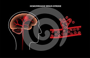 Brain stroke hemorrhagic