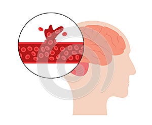 Brain stroke hemorrhagic