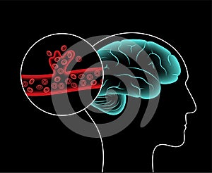 Brain stroke hemorrhagic