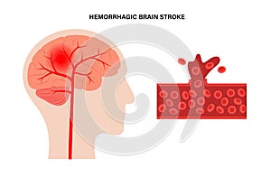 Brain stroke hemorrhagic photo