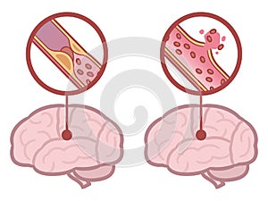 Brain stroke - ischemic and hemorrhagic