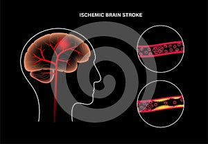 Brain stroke ishemic