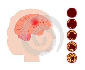 Brain stroke ishemic