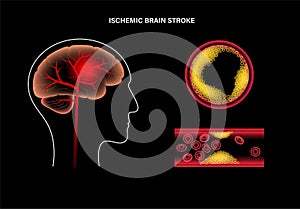 Brain stroke ishemic