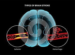 Brain stroke ishemic and hemorrhagic