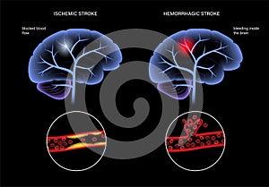 Brain stroke ishemic and hemorrhagic