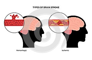 Brain stroke ishemic and hemorrhagic