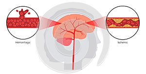 Brain stroke ishemic and hemorrhagic