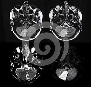 brain stroke, MRI