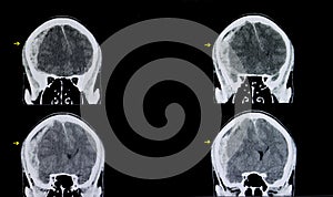 brain subarachnoid hemorrhage