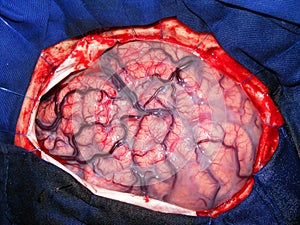 Brain surgery