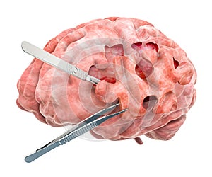 Brain surgery concept. 3D rendering
