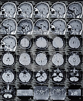 Brain tomograma