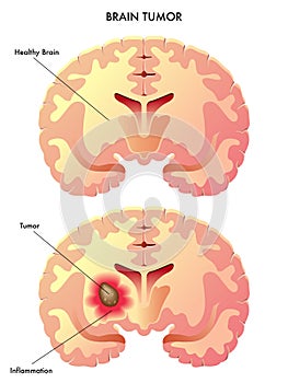 Brain tumor photo