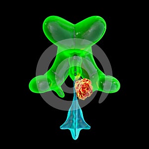 A brain tumor causing hydrocephalus, 3D illustration