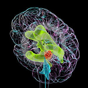 A brain tumor causing hydrocephalus, 3D illustration