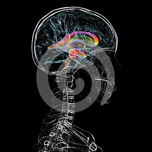 A brain tumor causing hydrocephalus, 3D illustration