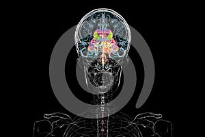 A brain tumor causing hydrocephalus, 3D illustration