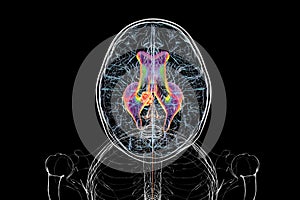 A brain tumor causing hydrocephalus, 3D illustration