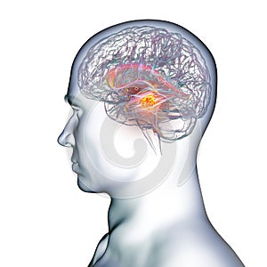 A brain tumor causing hydrocephalus, 3D illustration