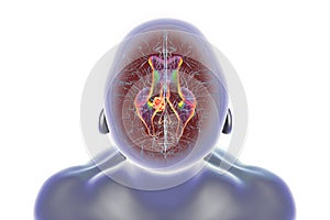 A brain tumor causing hydrocephalus, 3D illustration