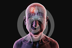 Brain tumor, 3D illustration