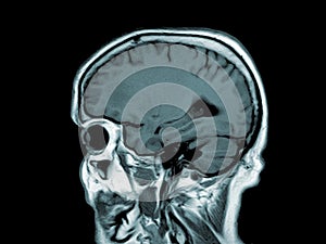 Brain tumor  Film CT-scan of brain : show part of brain with tumor
