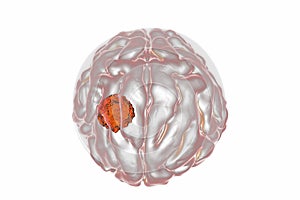 Brain tumor, illustration