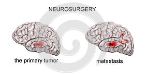 Brain tumor, neurosurgery