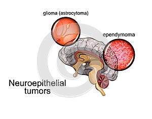 Brain tumour 2, neurosurgery