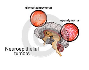 Brain tumour 2, neurosurgery photo
