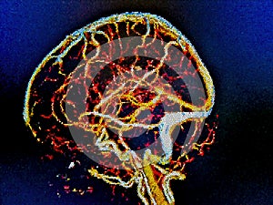 brain veins, CT illustration